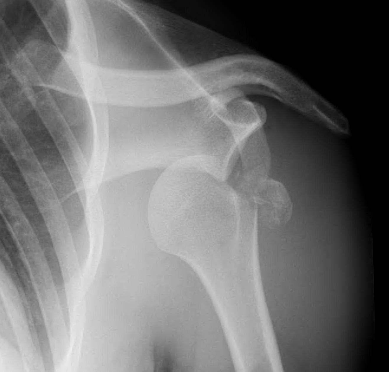 Shoulder Fracture Dislocation